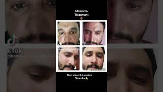 Melasma treatment 🫶🏼 doctor explore skintreatment [upl. by Sedinoel]