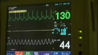 心電図モニター 実際の測定 ST上昇心筋虚血状態FUKUDADENSHI DINASCOPE DS7100 [upl. by Mabelle403]