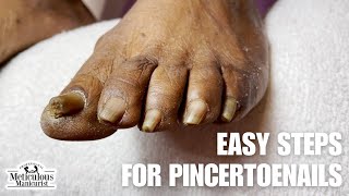 Fix your Ingrown Pincer Nails at Home [upl. by Horatia]