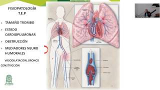 Tromboembolia pulmonar 2016 residencia udea [upl. by Aretak]