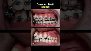 Teeth very crowded and crooked before braces orthodontist braces dentist [upl. by Urien]