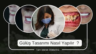 Gülüş Tasarımı Aşamaları Nelerdir  Nasıl Yapılır  Ne Kadar Zaman Gerekir  Dt Elnaz YILDIZ [upl. by Emirej]