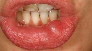 Traumatic Mucous Cyst  Oral Mucocele [upl. by Ellegna]