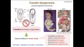 Caudal Dysplasia  Caudal regression syndrome  Abormal development of caudal part of spine [upl. by Barstow]