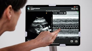 Fetal Heart Mmode [upl. by Loella888]