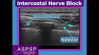 Intercostal Nerve Block [upl. by Ahsiekit]