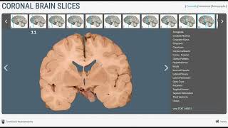 Neuroanatomy  Basal Ganglia in Brain Cross Sections [upl. by Miett]