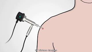 Arthroscopic Bankart Repair [upl. by Rutra]