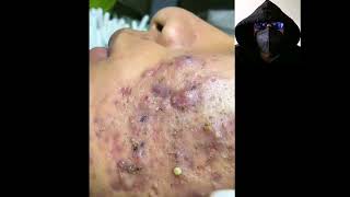 acne infeccioso muy agresivo en la cara extraccion de puntos negros y granos 1 [upl. by Nigem]