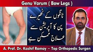 3 Genu Varum  Bow Legs   Dr Kashif Ramay  2018 [upl. by Telimay]