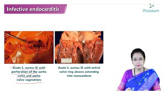 Infective Endocarditis Hindi  Internal Medicine [upl. by Flavia921]