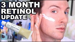 MY FIRST 3 MONTHS ON RETIN A  RETINOL BEFORE AND AFTER [upl. by Noby]