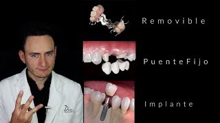 Puentes vs Implantes  ¿Cuál es la mejor opción  Dentista en Querétaro [upl. by Isolda739]