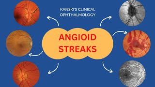 Angioid streaksKanskis clinical ophthalmology choroidal rupture ophthalmology kanski retina [upl. by Chiaki]