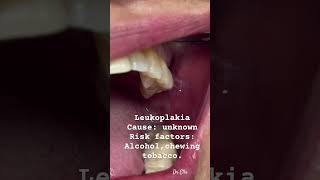 tooth toothdental leukoplakia  oral cancer  smokers  alcohol toothdoctor doctor oral health [upl. by Adelpho]