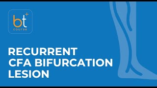 Course Preview Endovascular Treatment of a Recurrent CFA Bifurcation Lesion [upl. by Yenrab129]