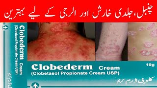 Clobederm cream uses in urdu  Clobetasol  Benefits  How to apply  Side effects  cream [upl. by Fitzgerald]