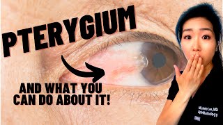 What Is A Pterygium  Causes Symptoms And Treatments For Surfers Eye [upl. by Oster767]