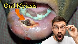 Oral myiasis disease symptoms treatment lifecycle [upl. by Maud]