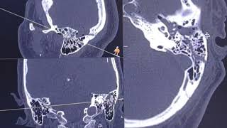 Complexed intracranial haemorrhage skull fracture and pleumocephalus  TRAUMA  CT findings [upl. by Aisitel32]