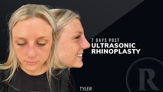 Tyler’s Story Ultrasonic Rhinoplasty PostOp Day 7 [upl. by Jephum84]