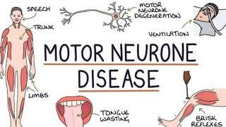 Motor Neuron Diseases Signs amp Symptoms  MND Homeopathic Treatment motorneuronedisease mnd [upl. by Choong809]