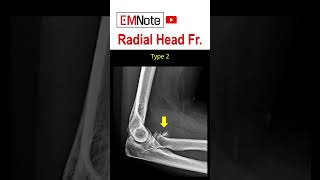 Radial Head Fracture [upl. by Enna]