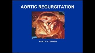 Aortic Stenosis and Regurgitation Variations [upl. by Bullen254]