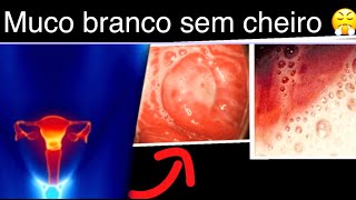 Como Acabar com Corrimento Vaginal branco sem cheiro [upl. by Las314]