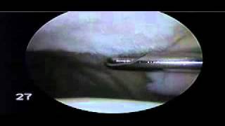 Chondroplasty Patella for Chondromalacia Patella  Dr Steven Struhl [upl. by Il]