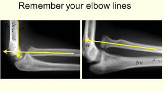 Monteggia Fractures  AMS [upl. by Bibi]