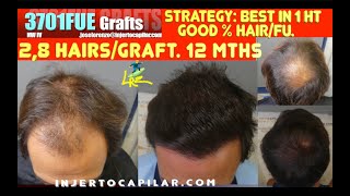 3701Grafts NW IV StrategyBest outcome in 1HT 12mths 28hairsgraftInjertocapilarcom28852023 [upl. by Triny]