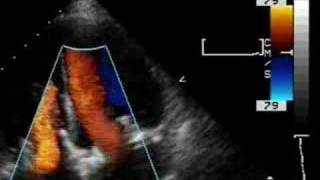 Prosthetic tricuspid valve and mitral valve [upl. by Pax]