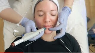 HYDRAFACIAL TREATMENT Before amp After [upl. by Ayikahs135]