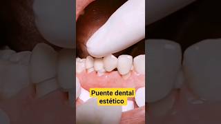 Cementacion de puente dental cerámico odontologia dentista shorts [upl. by Levina]