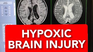 MRI of Hypoxic Ischaemic Brain Injury 10months Child shorts shortsvideo shortsvideos [upl. by Annaj211]