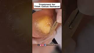 Palmoplantar Keratoderma Relief Expert Treatment for Thick Callus Removal by miss foot fixer [upl. by Gnivri]