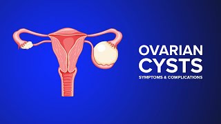 Ovarian Cysts  Symptoms and Complications Explained by an OBGYN [upl. by Aubert]