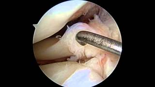 Lateral Meniscus Repair [upl. by Hayward]