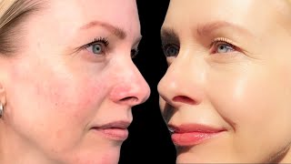 AZELAIC ACID  how to layer in your routine  it FIXED my ROSACEA [upl. by Amsed]