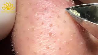 Best Satisfying Nose Plucking Blackheads Whiteheads Removal  Acne Treatment 52 [upl. by Nilac126]