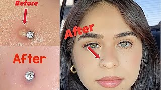 How to get rid of a nose piercing bump fast Keloid [upl. by Kimitri458]