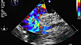 Interatrial Septal Aneurysm and Patent Foramen Ovale  Echocardiography [upl. by Mihsah]