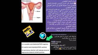 molar pregnancy شرح الحمل العنقودي [upl. by Vel]