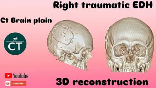 How did you make this  3D reconstruction Ct Scan Brain plain  Ge 32 revolution [upl. by Evy]