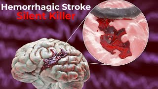 Hemorrhagic Stroke  causes symptoms diagnosis treatment pathology [upl. by Jit578]