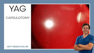 Routine YAG Capsulotomy [upl. by Marjy410]