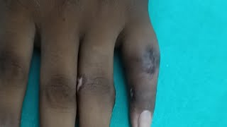 Do Finger Exercises After Surgery Actually Work [upl. by Anilad]