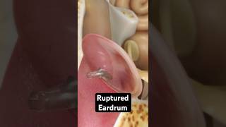 How does an eardrum rupture 3D Animation [upl. by Eudoxia]