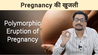 Pregnancy की खुजली  Polymorphic Eruption of Pregnancy PUPPP itching in pregnancy pregnancyskincare [upl. by Hevak458]